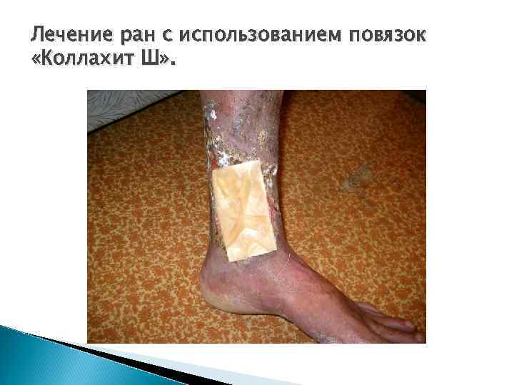 Лечение ран с использованием повязок «Коллахит Ш» . 