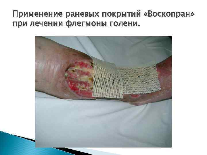 Применение раневых покрытий «Воскопран» при лечении флегмоны голени. 