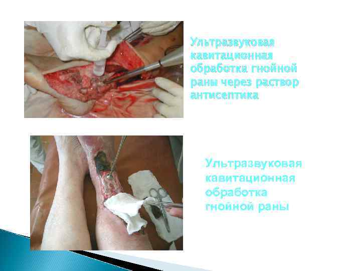 Ультразвуковая кавитационная обработка гнойной раны через раствор антисептика Ультразвуковая кавитационная обработка гнойной раны 