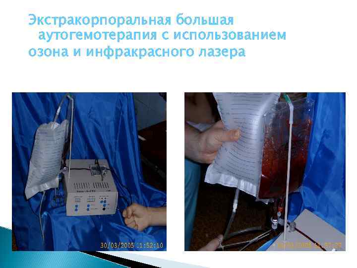 Экстракорпоральная большая аутогемотерапия с использованием озона и инфракрасного лазера 