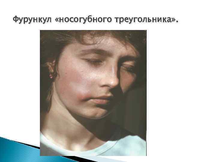 Фурункул «носогубного треугольника» . 
