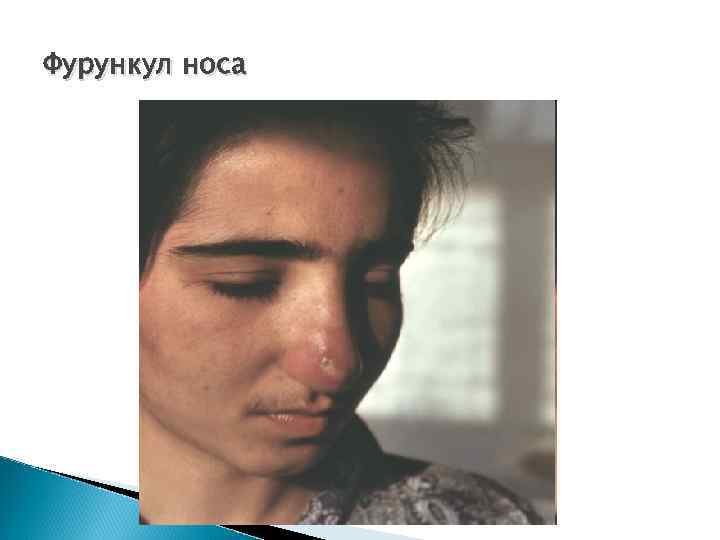 Фурункул носа 