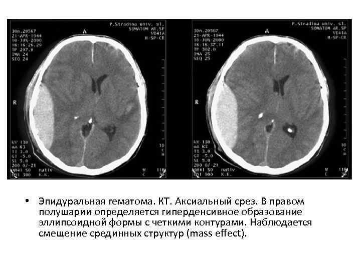  • Эпидуральная гематома. КТ. Аксиальный срез. В правом полушарии определяется гиперденсивное образование эллипсоидной