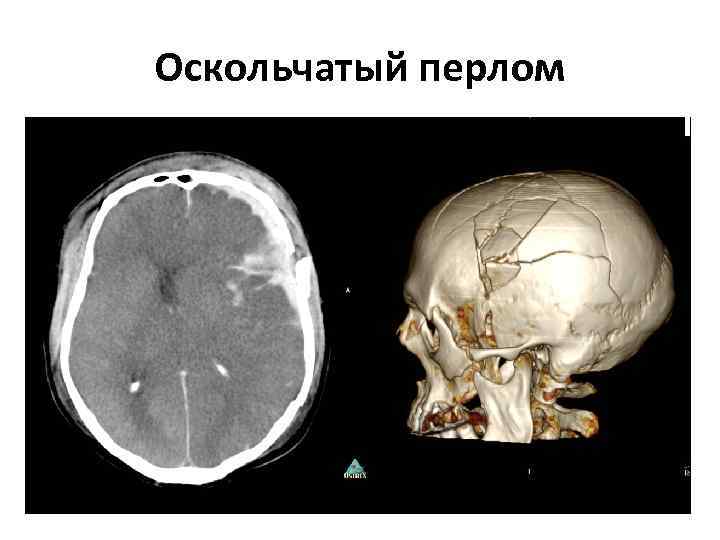 Оскольчатый перлом 