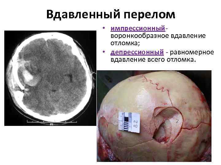 Вдавленный перелом • импрессионный- воронкообразное вдавление отломка; • депрессионный - равномерное вдавление всего отломка.