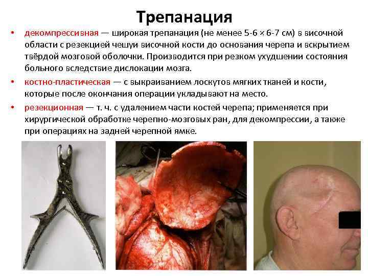  • • • Трепанация декомпрессивная — широкая трепанация (не менее 5 -6 ×