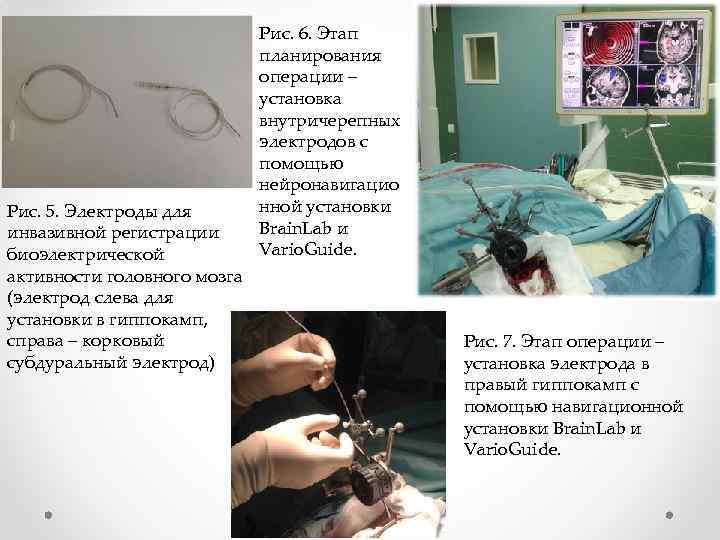 Рис. 5. Электроды для инвазивной регистрации биоэлектрической активности головного мозга (электрод слева для установки