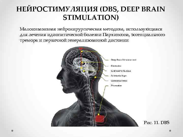 НЕЙРОСТИМУЛЯЦИЯ (DBS, DEEP BRAIN STIMULATION) Малоинвазивная нейрохирургическая методика, использующаяся для лечения идиопатической болезни Паркинсона,