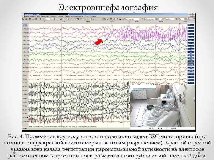 Клиническая электроэнцефалография с элементами эпилептологии руководство для врачей