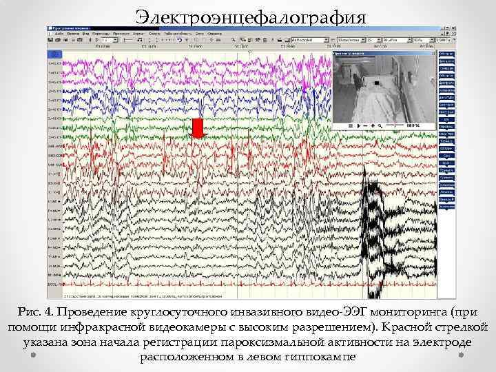 Электроэнцефалография Рис. 4. Проведение круглосуточного инвазивного видео-ЭЭГ мониторинга (при помощи инфракрасной видеокамеры с высоким