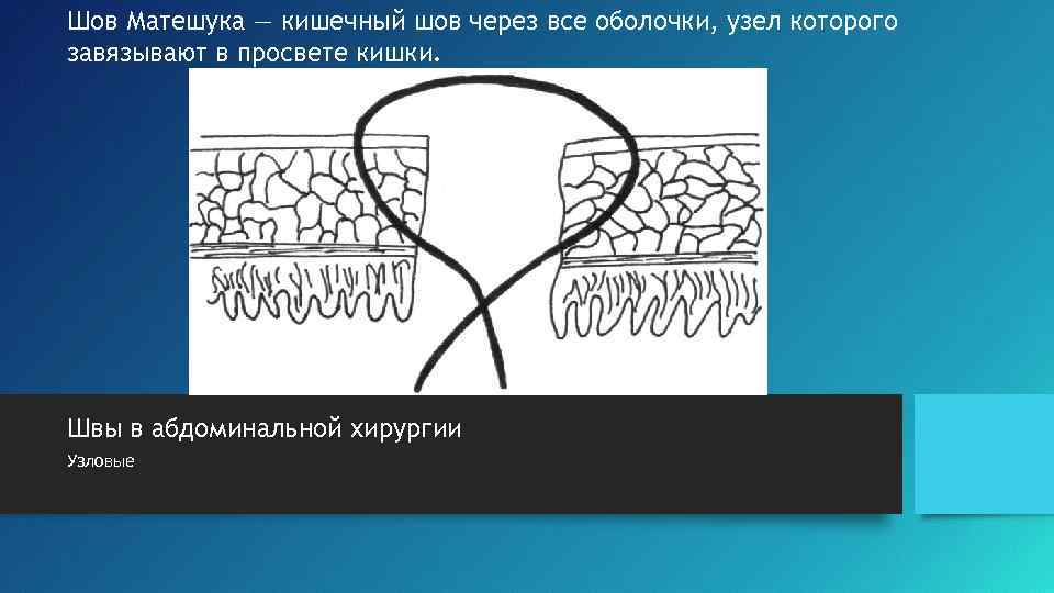 Шов Матешука — кишечный шов через все оболочки, узел которого завязывают в просвете кишки.