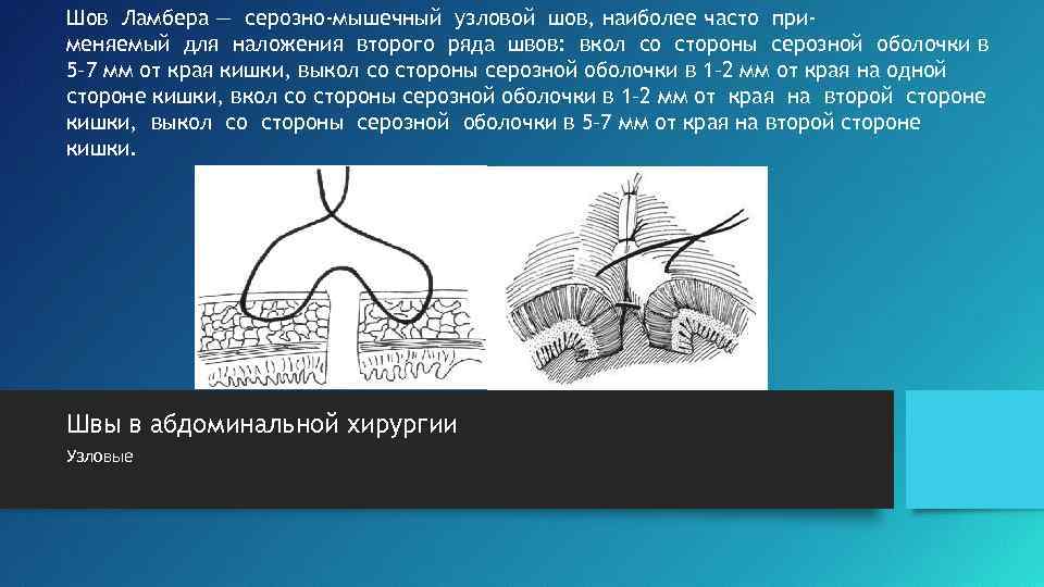 Шов Ламбера — серозно-мышечный узловой шов, наиболее часто применяемый для наложения второго ряда швов: