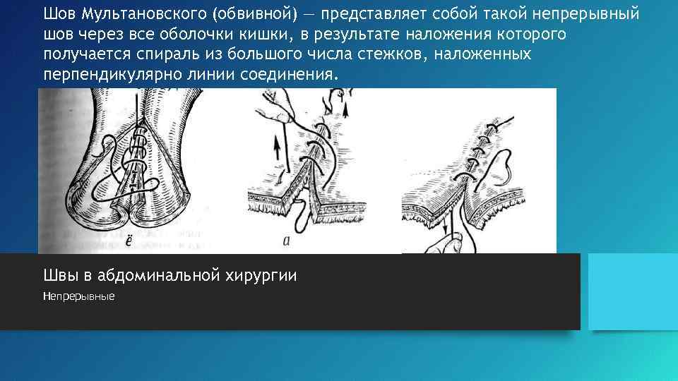 Шов Мультановского (обвивной) — представляет собой такой непрерывный шов через все оболочки кишки, в