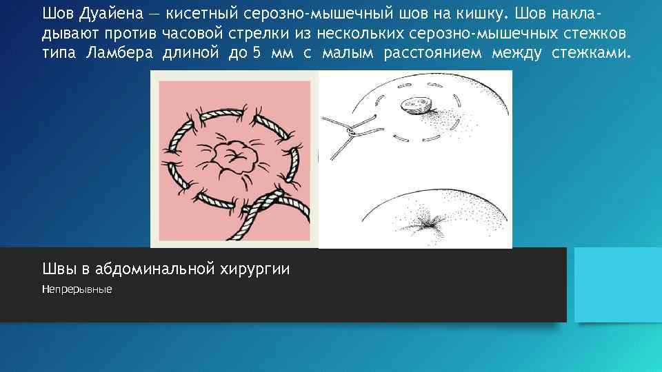 Шов Дуайена — кисетный серозно-мышечный шов на кишку. Шов накладывают против часовой стрелки из