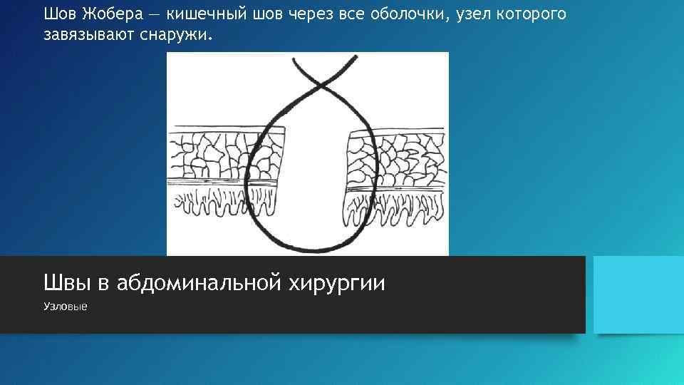 Шов Жобера — кишечный шов через все оболочки, узел которого завязывают снаружи. Швы в