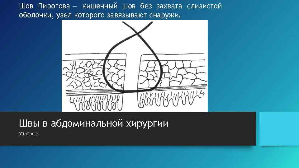 Шов Пирогова — кишечный шов без захвата слизистой оболочки, узел которого завязывают снаружи. Швы