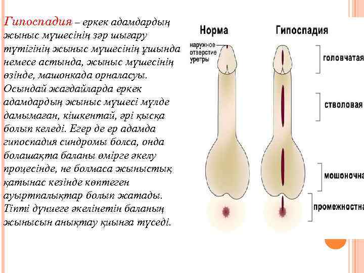 Гипоспадия – еркек адамдардың жыныс мүшесінің зәр шығару түтігінің жыныс мүшесінің ұшында немесе астында,
