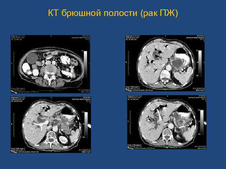 КТ брюшной полости (рак ПЖ) 