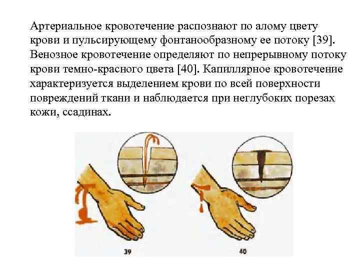 Артериальное кровотечение распознают по алому цвету крови и пульсирующему фонтанообразному ее потоку [39]. Венозное