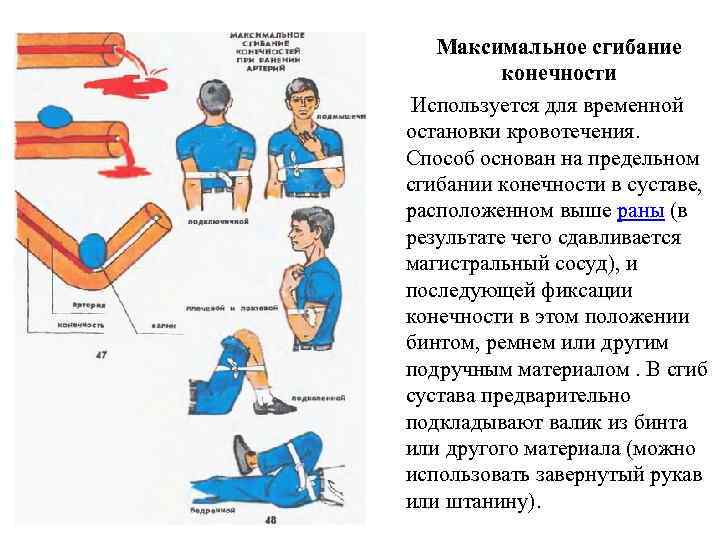 Максимальное сгибание конечности Используется для временной остановки кровотечения. Способ основан на предельном сгибании конечности