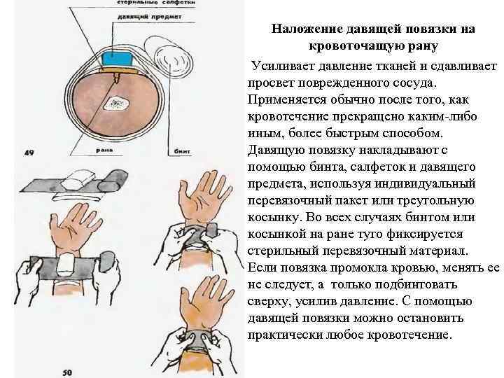 Наложение давящей повязки на кровоточащую рану Усиливает давление тканей и сдавливает просвет поврежденного сосуда.