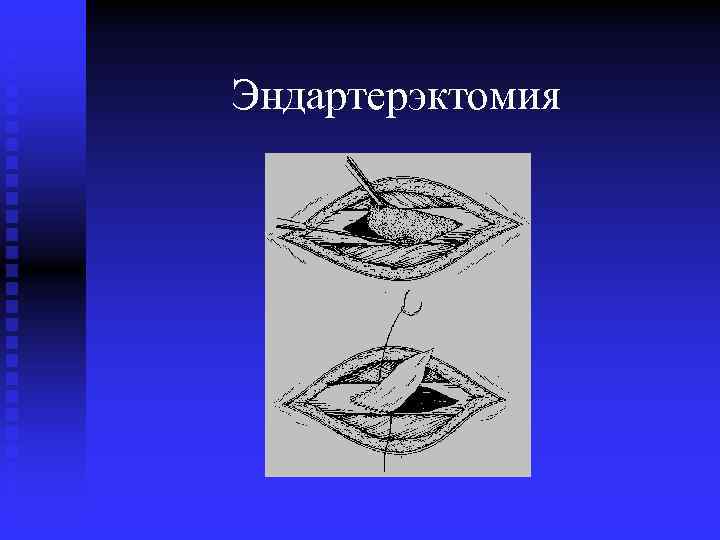 Эндартерэктомия 