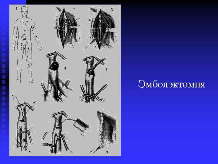 Эмболэктомия 