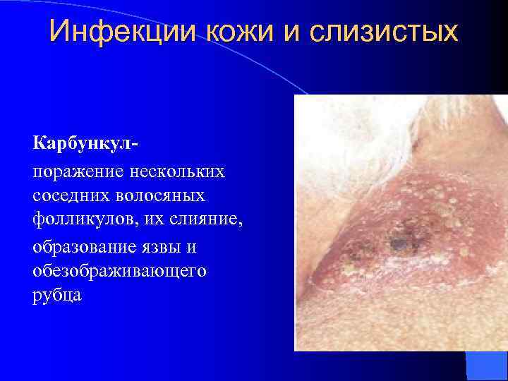 Инфекции кожи и слизистых Карбункулпоражение нескольких соседних волосяных фолликулов, их слияние, образование язвы и