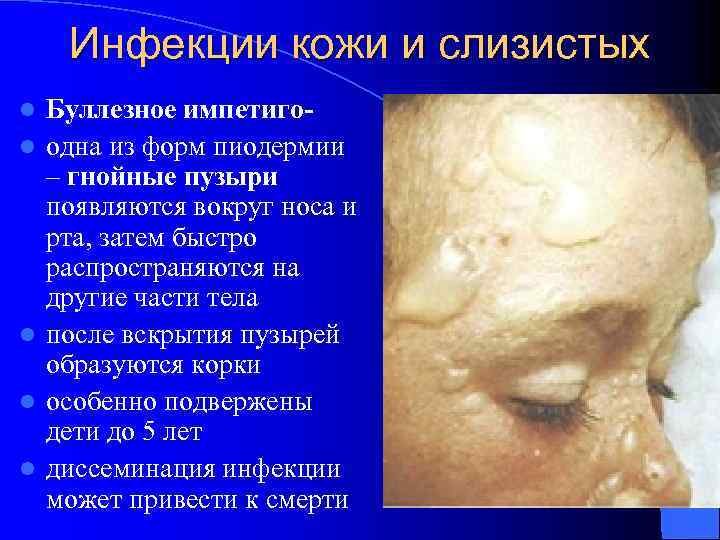 Инфекции кожи и слизистых l l l Буллезное импетигоодна из форм пиодермии – гнойные