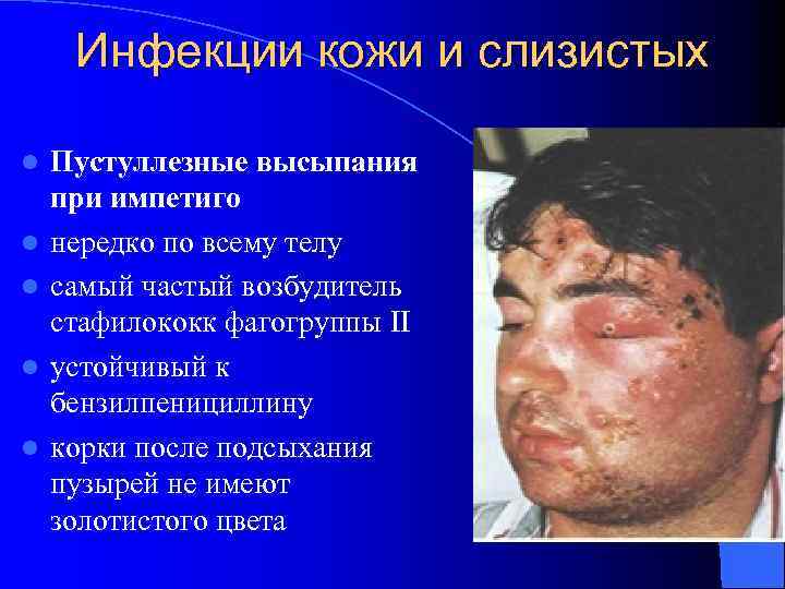 Инфекции кожи и слизистых l l l Пустуллезные высыпания при импетиго нередко по всему