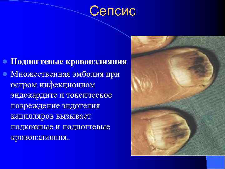 Сепсис Подногтевые кровоизлияния l Множественная эмболия при остром инфекционном эндокардите и токсическое повреждение эндотелия