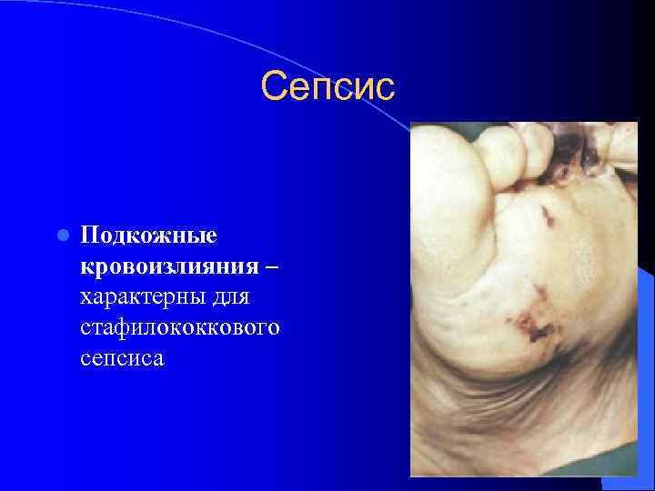 Сепсис l Подкожные кровоизлияния – характерны для стафилококкового сепсиса 
