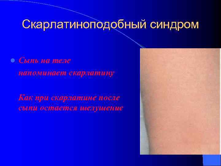 Скарлатиноподобный синдром l Сыпь на теле напоминает скарлатину Как при скарлатине после сыпи остается