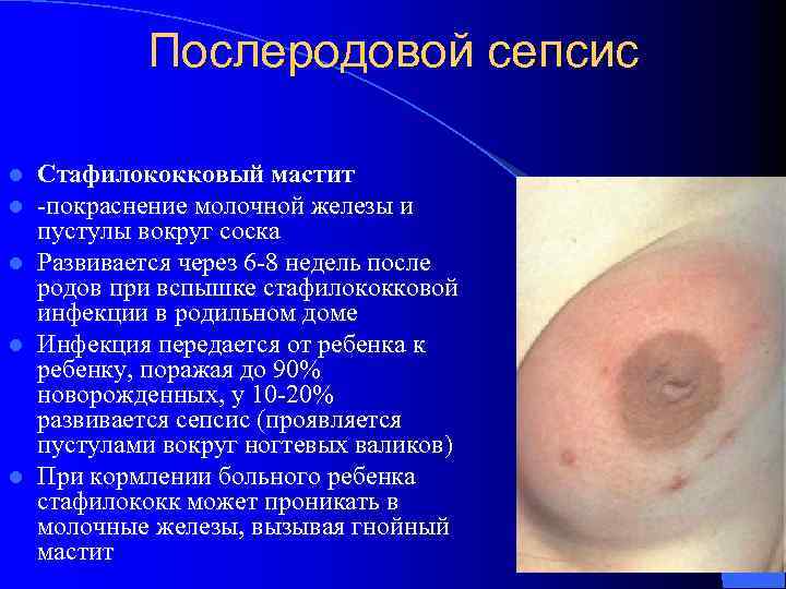 Послеродовой сепсис Стафилококковый мастит -покраснение молочной железы и пустулы вокруг соска l Развивается через