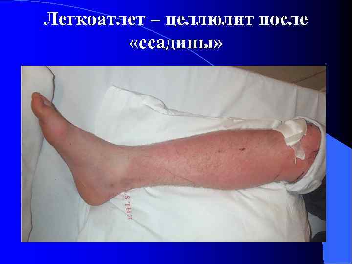 Легкоатлет – целлюлит после «ссадины» 