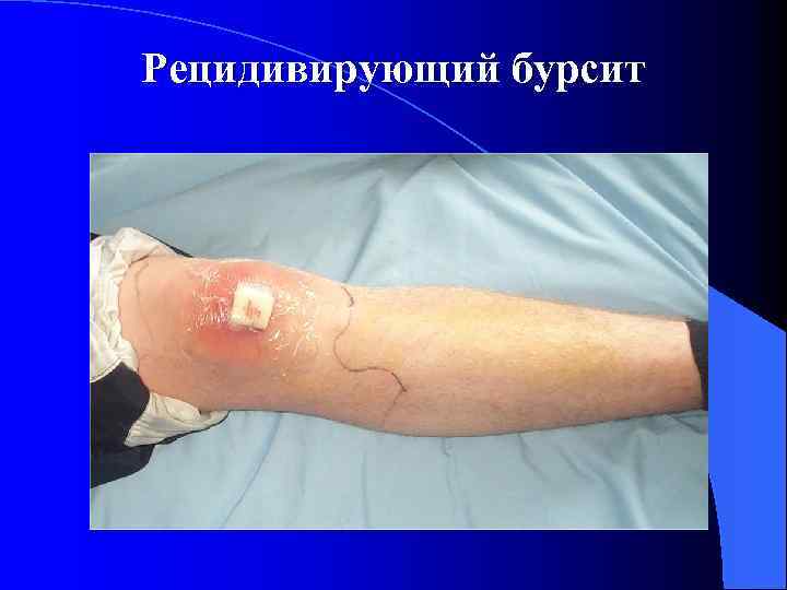 Рецидивирующий бурсит 