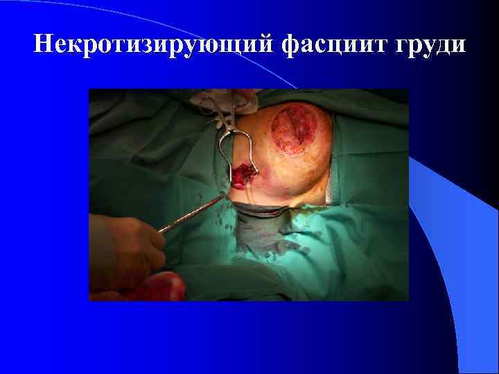 Некротизирующий фасциит груди 