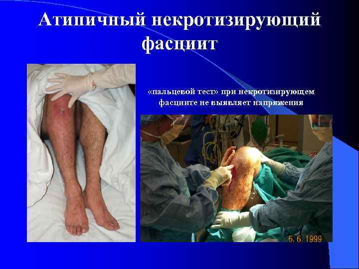 Атипичный некротизирующий фасциит «пальцевой тест» при некротизирующем фасциите не выявляет напряжения 