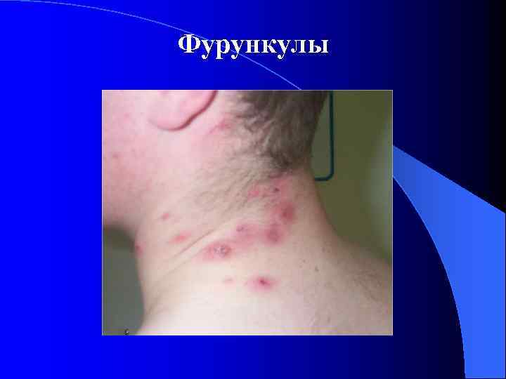 Фурункулы 