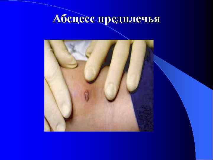 Абсцесс предплечья 