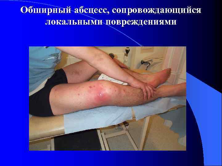 Обширный абсцесс, сопровождающийся локальными повреждениями 