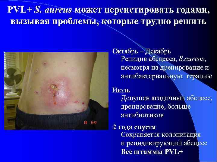 PVL+ S. aureus может персистировать годами, вызывая проблемы, которые трудно решить Октябрь – Декабрь