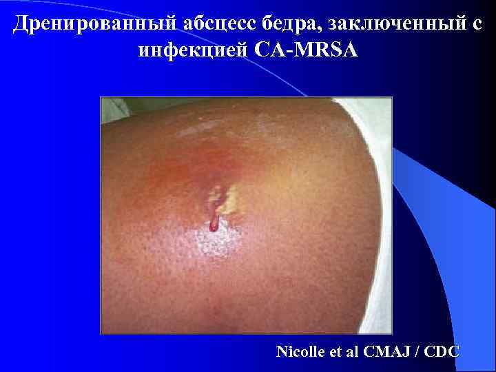 Дренированный абсцесс бедра, заключенный с инфекцией CA-MRSA Nicolle et al CMAJ / CDC 