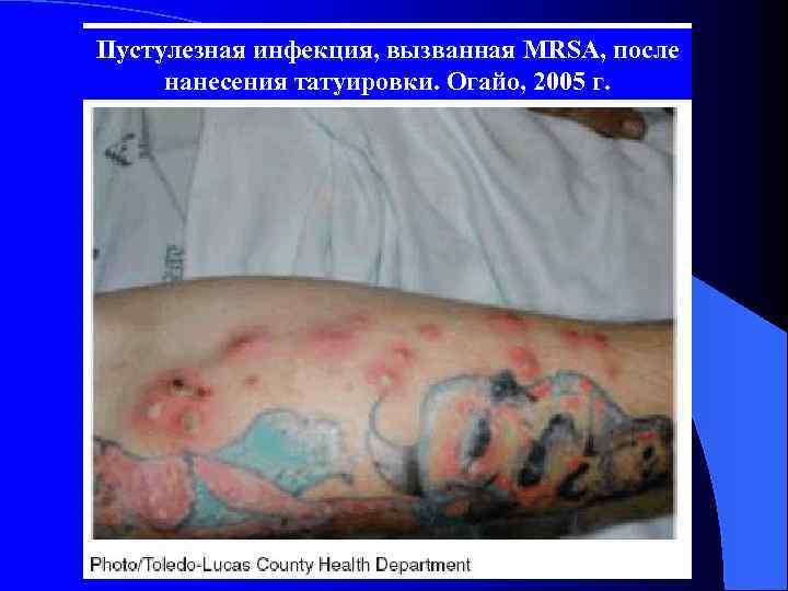 Пустулезная инфекция, вызванная MRSA, после нанесения татуировки. Огайо, 2005 г. 