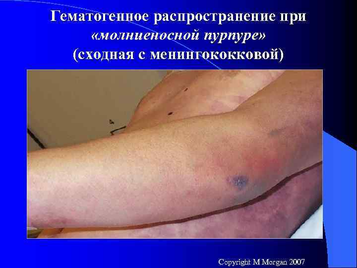 Гематогенное распространение при «молниеносной пурпуре» (сходная с менингококковой) Copyright M Morgan 2007 