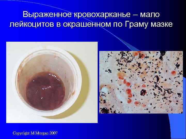 Выраженное кровохарканье – мало лейкоцитов в окрашенном по Граму мазке Copyright M Morgan 2007