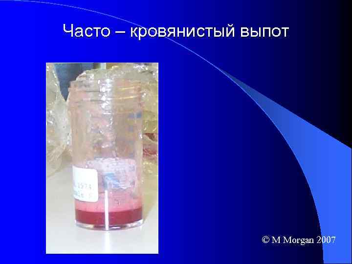 Часто – кровянистый выпот © M Morgan 2007 