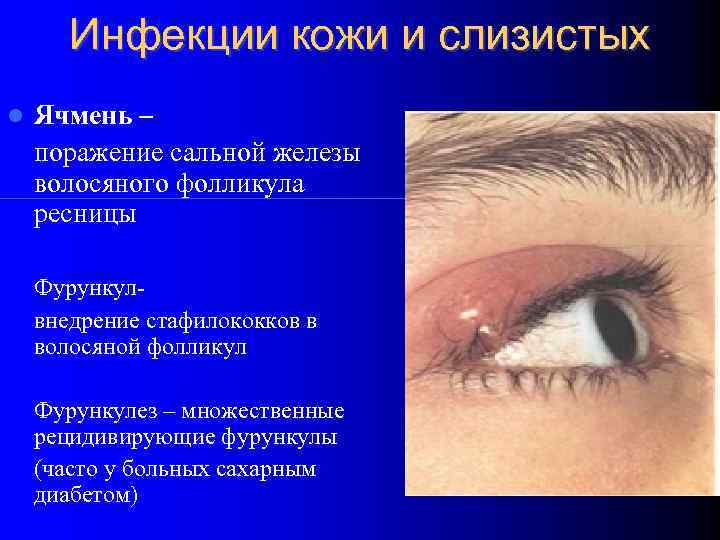 Инфекции кожи и слизистых Ячмень – поражение сальной железы волосяного фолликула ресницы Фурункулвнедрение стафилококков