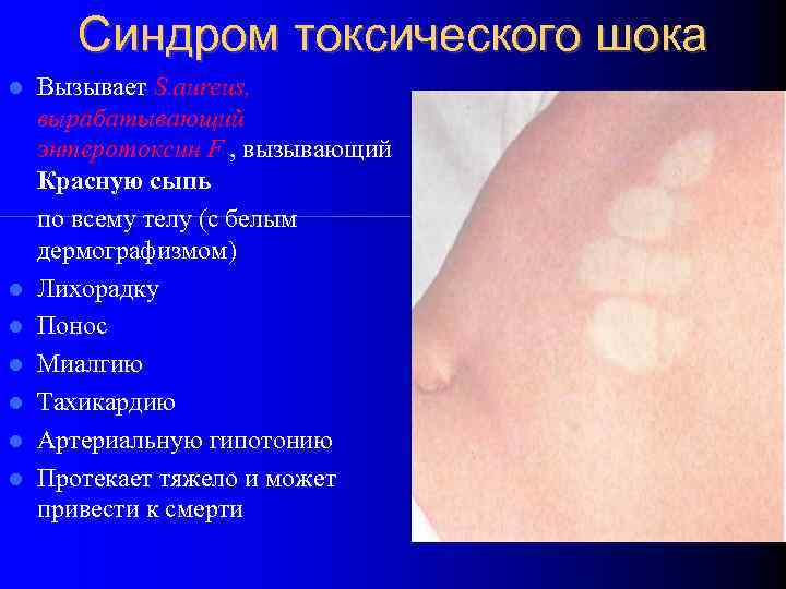 Синдром токсического шока Вызывает S. aureus, вырабатывающий энтеротоксин F , вызывающий Красную сыпь по