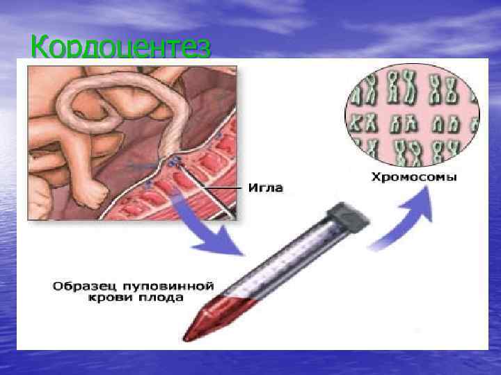 Кордоцентез 